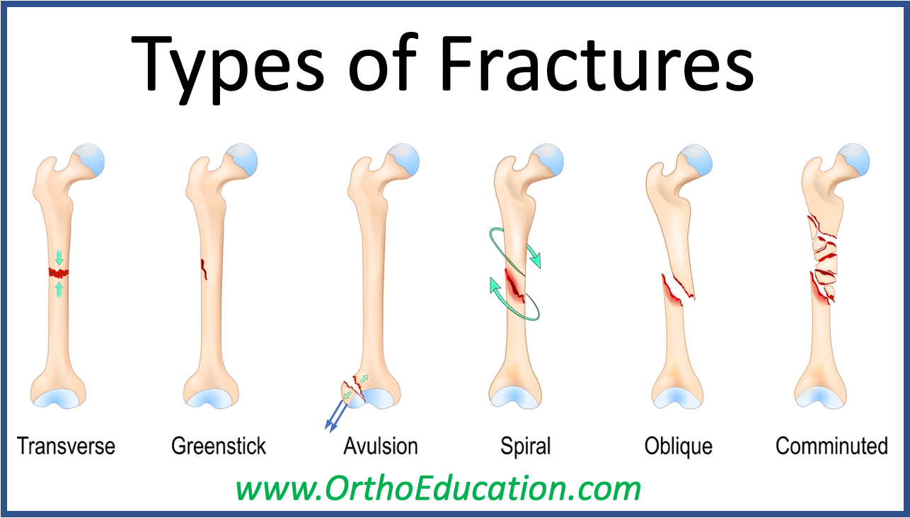 Types of Fractures