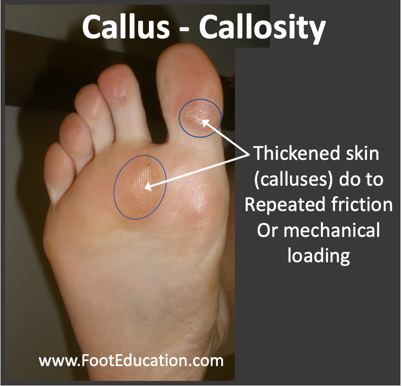 Callus -Callosity