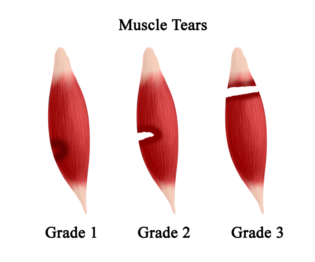 Grades of muscle strains