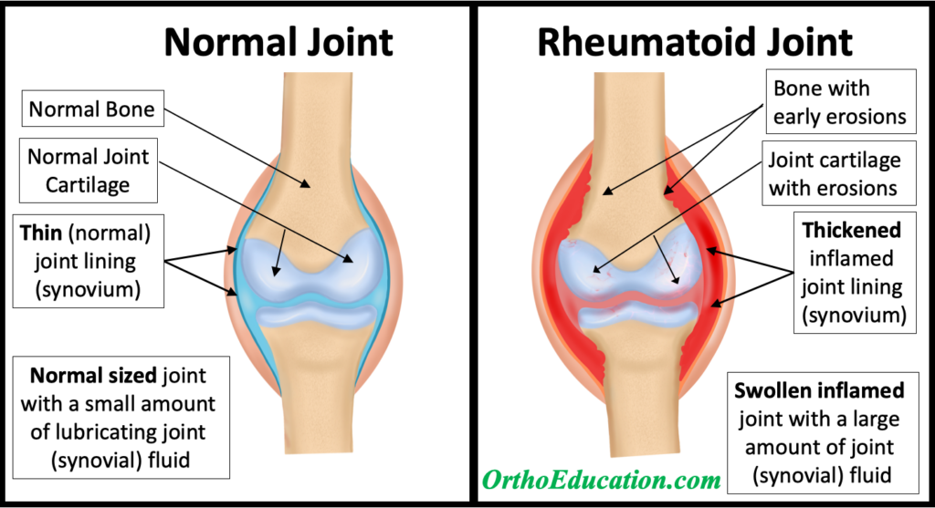 Rheumatoid Joint compared to Normal Joint